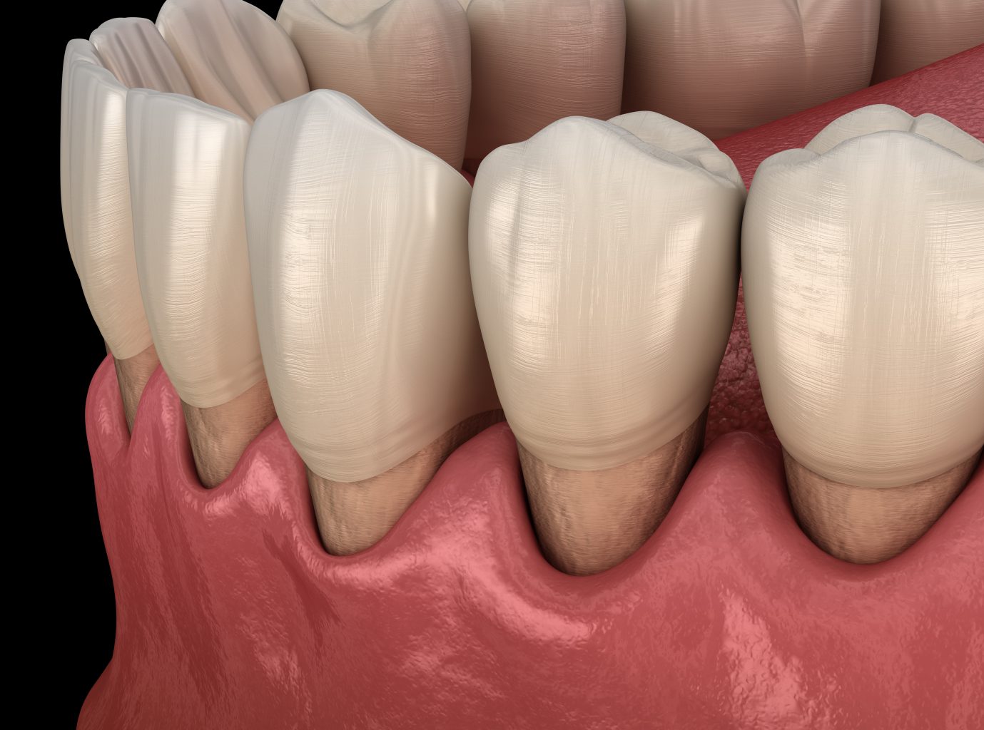 Gum Recession Process. Medically Accurate 3d Illustration